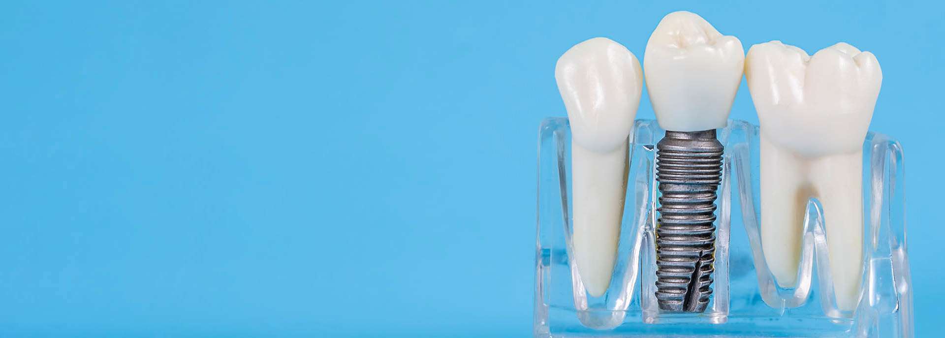 Dental Implants with Abutments and Crowns